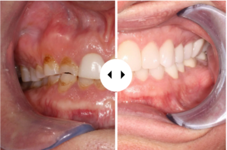 Before and after full mouth restoration
