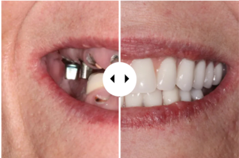 Before and after implant-supported crowns