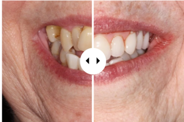 Before and after veneers