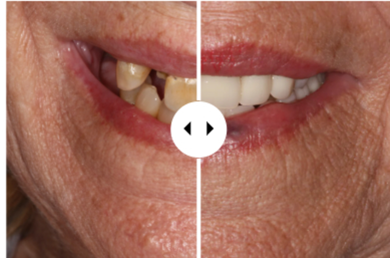 Before and after smile reconstruction