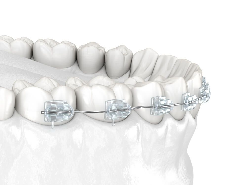 Clear ceramic braces on a model of the lower teeth